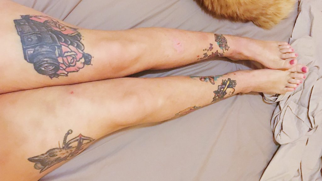 piernas después de la cirugía de lipedema en piernas