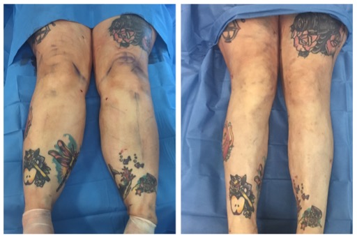 proceso cirugia de lipedema en piernas