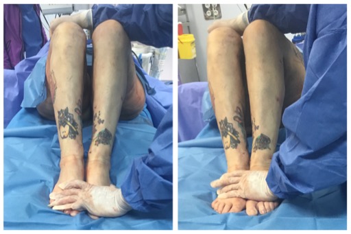 resultado cirugia de lipedema en piernas